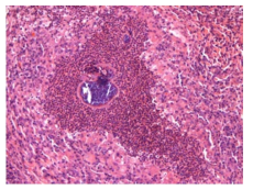 25VHF124; Inflammation, pyogranulomatous