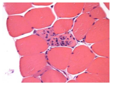 25VHF132; Degeneration/Necrosis with mononuclear cell infiltrate