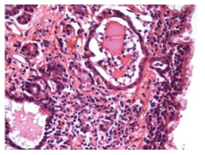 25VHM054; Inflammation, chronic active