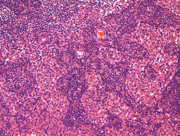 25VHM060; Cellularity, increased, macrophage, sinusoidal