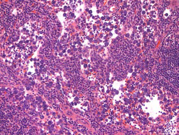 25VHM072; Cellularity, increased, mast cell, sinusoidal