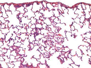 25CM004; Infiltrate, alveolar macrophage and mononuclear cell, subpleural