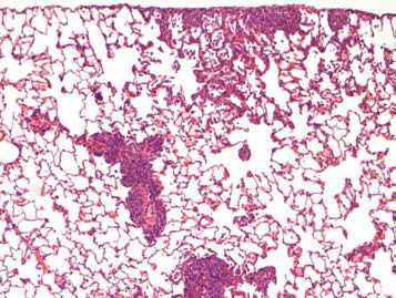 25CM001; Infiltrate, alveolar macrophage and mononuclear cell, subpleural and perivascular