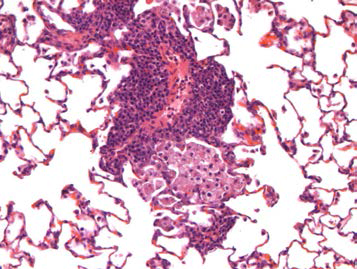 25CM008; Infiltrate, alveolar macrophage and mononuclear cell, perivascular