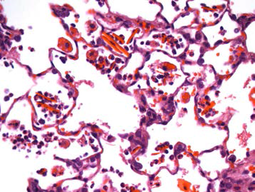 25CM008; Eosinophilic crystal with hemorrhage