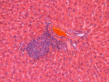 25VHM059; Infiltrate, mononuclear cell, focal, minimal