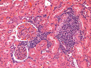 25VHM071; Infiltrate, mononuclear cell