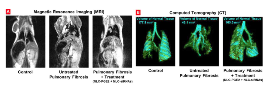 NLC hybird system을 이용한 fibrosis 치료 검증. (좌) MRI, (우) CT (Nanomedicine: Nanotechnology, Biology and Medicine, 2017, 13.6: 1983～1992)