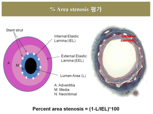 Percent area stenosis 평가