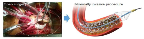 위험성이 높은 기존의 개흉 수술에서 카테터 기반의 최소침습시술의 변화