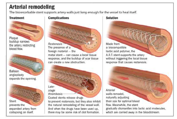 BMS 및 DES의 시술 후 발생하는 문제점