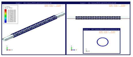 유한요소해석을 통한 스텐트 성능 평가