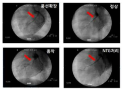혈관 조영술을 이용한 생분해성 고분자 스텐트 평가