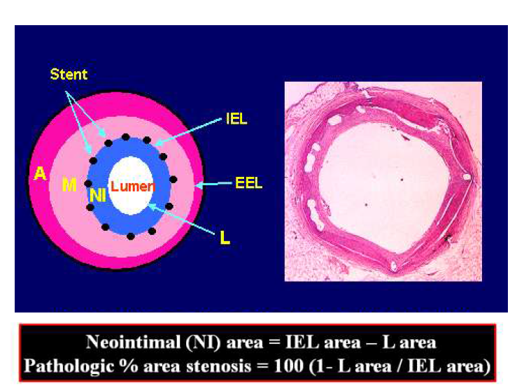 스텐트의 조직학적 분석