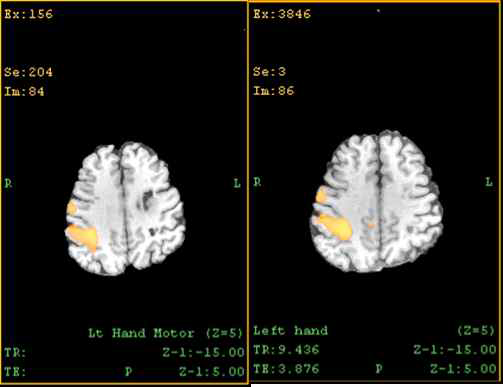 P2 좌측 (건 측) 손 움직임에 따른 기능적 뇌 자기공명영상 변화우; 재활치료 전좌; 재활치료 6개월 후