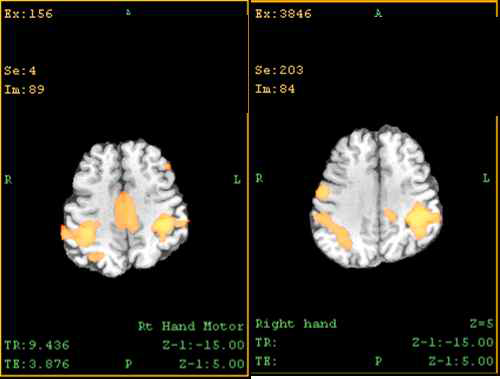 P2 우 측 (환 측) 손 움직임에 따른 기능적 뇌 자기공명영상 변화우; 재활치료 전좌; 재활치료 6개월 후