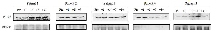 제대혈 세포 치료 후 각 환자에서의 PTX3 의 변화 (Western blot)