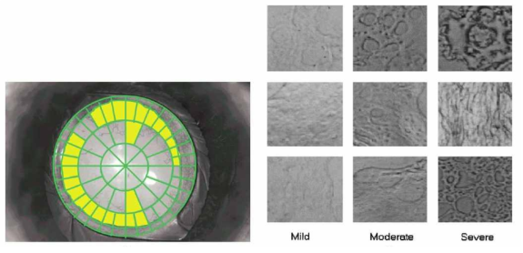 POCOman프로그램을 이용하여 후발백내장의 면적(Area: 좌측사진 노란색부분)과 심한 정도(Grade of Severity: 우측 사진을 기준자료로 평가)을 분석함 (J Cataract Refract Surg 2004; 30:2058–63)