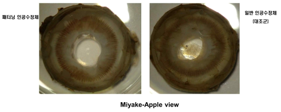 가토 백내장 수술 후 2달째 패터닝 Miyake-Apple view에서 패터닝 인공 수정체 삽입한 경우(좌측), 대조군(우측)에 비해 후발 백내장이 억제됨을 관찰하였음