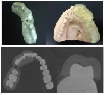 Ray 제작 서지컬가이드 및 CBCT로 확인한 내면 적합도