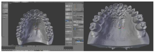 CAD software로 dental model에 ball을 삽입, true model을 완성한 STL 파일