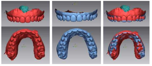 IOS STL (왼쪽), 고해상도 CBCT STL (가운데), 비교를 위한 두 데이터의 중첩 (왼쪽)