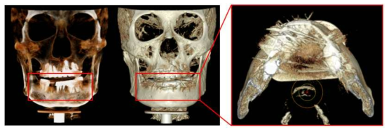 환자의 보철물로 인해 발생하는 CBCT영상의 metal artifact 및 3D 랜더링