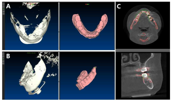 환자 CBCT 3D 랜더링 이미지와 디지털 모델 중첩 방법 예시