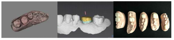 CBCT scan STL과 임시치아 디자인, 그리고 3D printed 임시치아