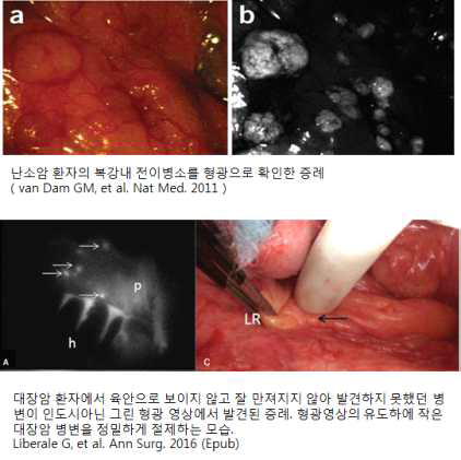 환자 맞춤형 정밀진단과 접목된 암수술의 예