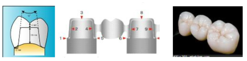 싱글 크라운과 3Unit 보철물 구조 비교