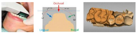 구강 내 Scanner 및 3D Surface Data 구성