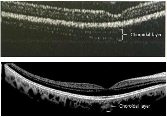 (상) 2차년도에 촬영한 model eye에 대한 망막 OCT 영상, (하) 3차년도에 촬영한 건강한 눈을 가진 사람의 in-vivo 망막 OCT 영상