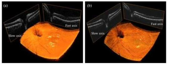 (a),(b)는 각기 다른 환자 망막의 3차원 OCT영상