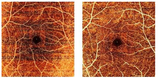 비필터 방식 파장가변 레이저 기반의 OCT Anigography 시스템으로 획득한 망막의 혈관 영상