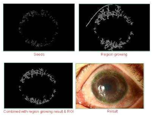 안구 표면의 혈관영상에서 픽셀 이미지의 segmentation 영상 구현을 위한 region growth 알고리즘