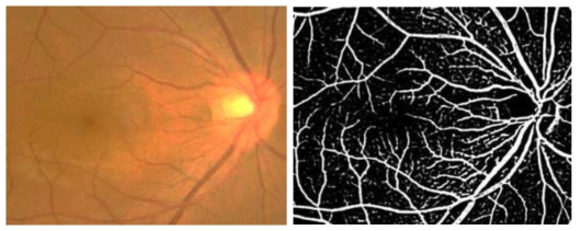 개발된 segmentation 알고리즘을 피시험자의 안저 촬영 영상(좌)에 적용하여 혈관부분의 영상만을 추출한 영상(우)