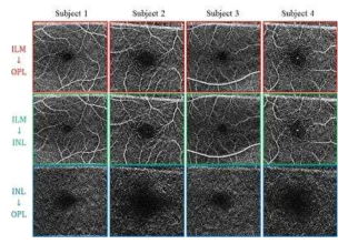 각기 다른 4명의 피시험자에 대한 망막 층별 혈관 영상. 각 피험자의 혈관 영상은 각각의 망막 OCT 영상에서 획득한 분리면의 깊이정보를 바탕으로 구성되었음