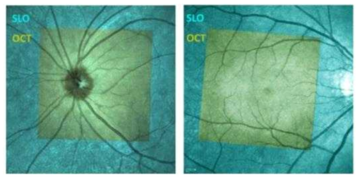 cyan 색은 스캐닝 레이저 검안경(SLO)의 이미지를 배경 영상과 노란색의 MA가 보정된 OCT 영상을 겹쳐 놓아서 MA가 보정된 정도의 비교