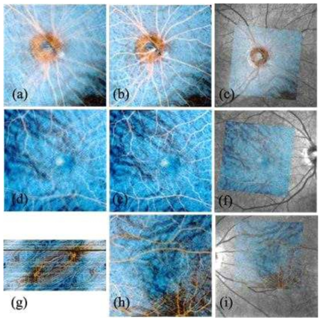 개발된 MA 보정 방법의 효과를 확인하기 위해서, MA 보정 이전의 en-face 영상 (a, d)과 MA 보정 이후 (b, e)의 비교와, 함께 획득된 SLO 이미지와 중첩하여 비교(c, f). 눈의 깜박거림이 더해진 OCT-A 영상(g), 의 깜박거림이 더해진 OCT-A 영상을 MA 보정한 경우(h), 깜박거림이 더해진 경우에 함께 획득된 SLO 이미지와 중첩하여 비교(i)