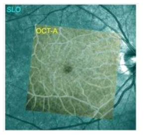 En face OCT-A image (yellow) overlaid on a scanning laser ophthalmoscope (SLO) image (cyan). Because the SLO image is regarded as a motion-free reference standard, this image demonstrates that our method provides a sufficient motion correction capability