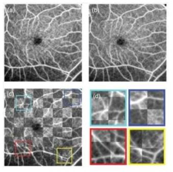 (c) Checkerboard image created from the two motion-corrected en face images that were shown in (a) and (b), where the brighter squares are from (a) and the darker squares are from (c). (d) shows a set of magnified images of (c), in which the colored boxes indicate the magnified region.