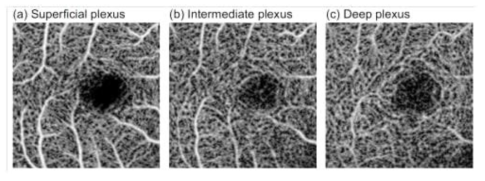 En face OCT-A images of three retinal vascular plexuses. (a) Superficial plexus; from the ILM to 24.8 μm above the IPL-INL boundary. (b) Intermediate plexus; ± 24.8 μm around the IPL-INL boundary. (c) Deep plexus; from 24.8 μm below the IPL-INL boundary to the OPL-HFL boundary