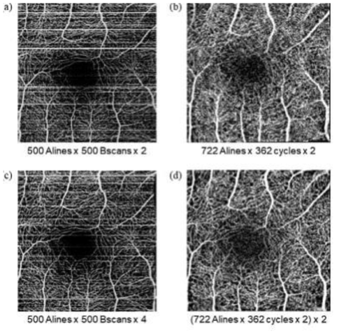 본 연구진이 개발한 OCTA 시스템으로 획득한 망막에서의 혈관영상. 일반적인 Raster 스캔 패턴으로 획득한 영상(a, c)과 Lissajous 스캔 패턴으로 영상보정한 영상(b, d)