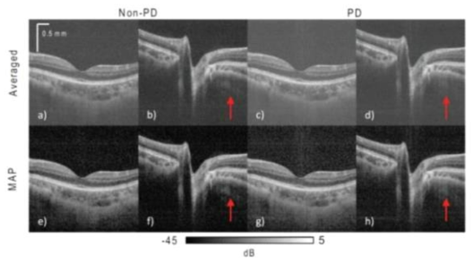 Intensity images of the macula and ONH. The four images on the left hand side (a), (b), (e) and (f) are non-PD OCT images. The four images on the right (c), (d), (g) and (h) are PD-OCT images. The images on the first row are composed by intensity averaging of four repeated B-scans. Images on the second row are composed by MAP estimation from the same four repeated B-scans. Zero dB corresponds to the 99.9th percentile highest intensity in each image. The SIRs between the retinal pigment epithelium and vitreous, calculated from the macula images, are 31.1 dB for the MAP non-PD-OCT (e), 24.5 dB for averaging non-PD-OCT (a), 28.4 dB for MAP PD-OCT (g), and 21.7 dB for averaging PD-OCT