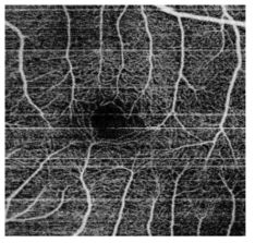 투영 알고리즘으로 획득한 안구의 혈관 영상
