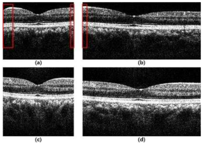 일반 스캐너와 고속 스캐너로 획득한 OCT 영상. (a)와 (b)는 일반 스캐너를, (c) 와 (d)는 고속 스캐너를 사용하여 획득한 영상임