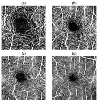 스캔 범위와 픽셀 수를 달리하여 획득한 혈관영상. (a) 2mm x 2mm (260 pixel x 260 pixel), (b) 3mm x 3mm (260 pixel x 260 pixel), (c) 3mm x 3mm (300 pixel x 300 pixel), (d) 5mm x 5mm (500 pixel x 500 pixel)
