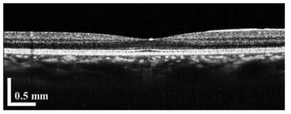 400kHz swept source를 이용하여 획득한 망막의 단면 영상
