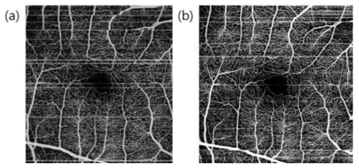 100kHz swept source OCT로 획득한 angiogram(a)와 400kHz VCSEL OCT로 획득한 angiogram(b). 두 개의 영상은 아무 처리를 하지 않은 데이터임